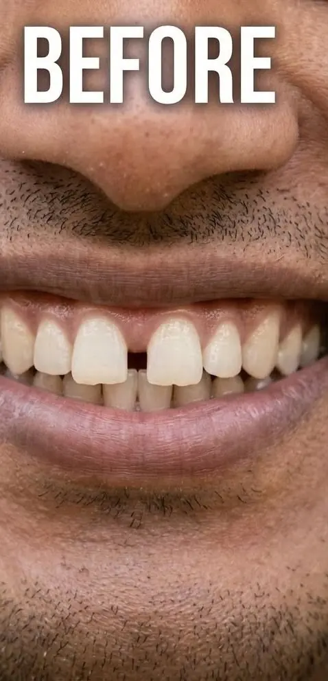 Before: a visible gap between the upper front teeth